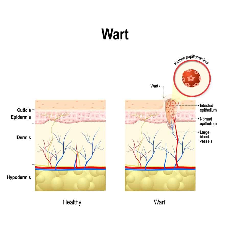 hpv virus hals symptom sulfat de magneziu injectabil