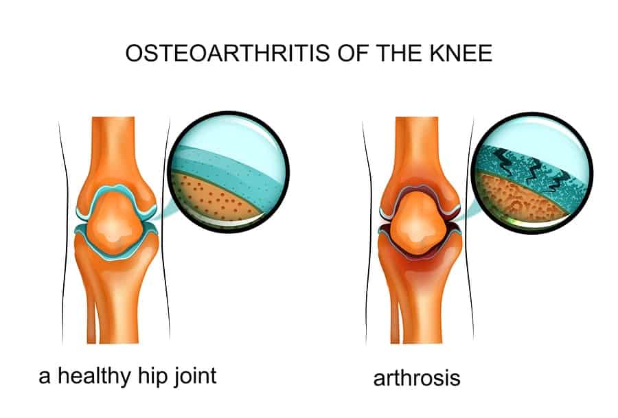 osteoartritida