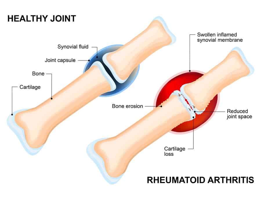 revmatoidní artritida